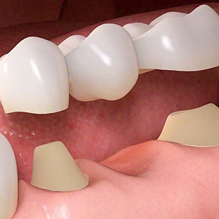 img-FILLINGS,-CROWNS-&-BRIDGES