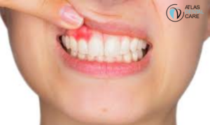 Prevent Gum Problems, Dentist in El Monte, Atlas Dental Care