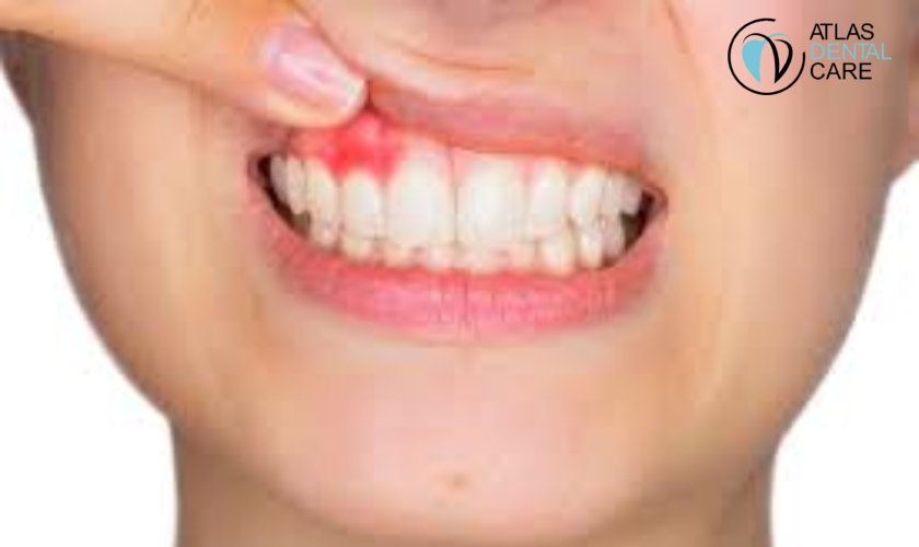 Prevent Gum Problems, Dentist in El Monte, Atlas Dental Care