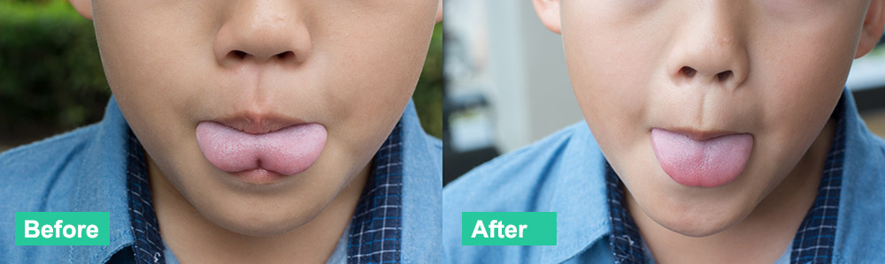 beforeafter_frenectomy