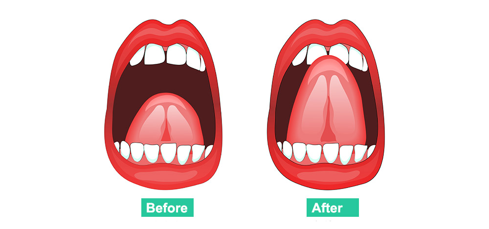 frenectomy_beforeafter