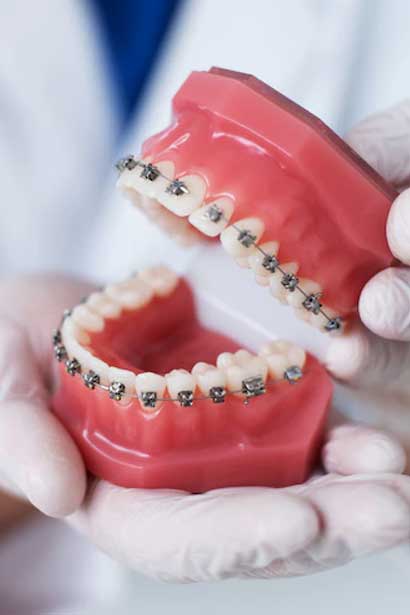 how-braces-work-img