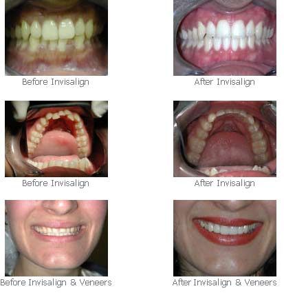 invisalign_before_after invisalign_before_after