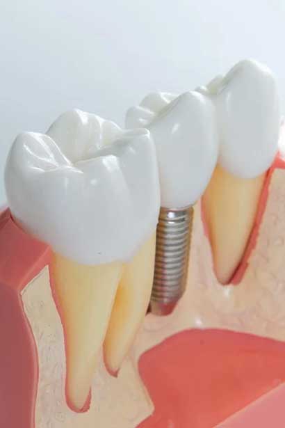 why-you-should-choose-dental-implants-img